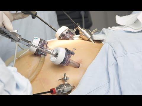 Laparoscopic Gastric Bypass Surgery