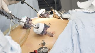 Laparoscopic Gastric Bypass Surgery