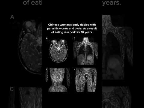 Chinese Woman S Body Riddled With Parasitic Worms As A Result Of Eating Raw Pork For 10 Years 