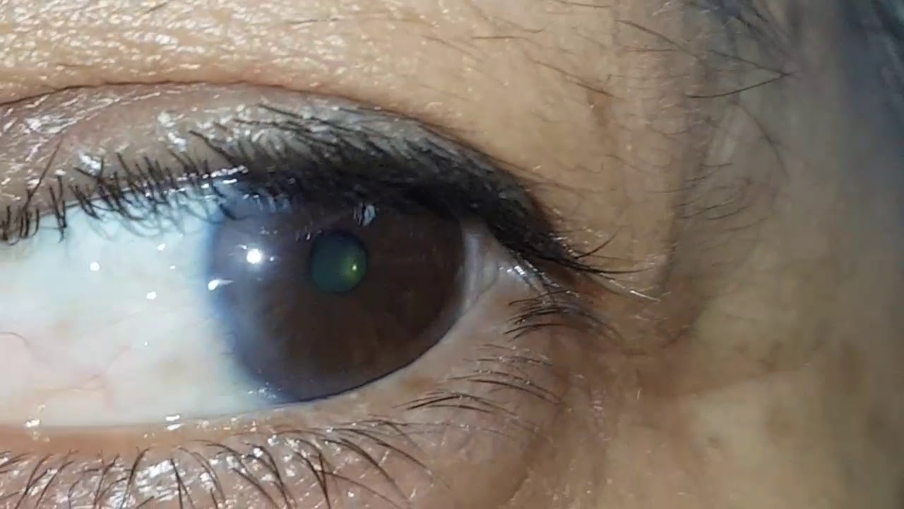 Antes y después de Cirugia de PTERIGION más injerto ambos ojos Virginia