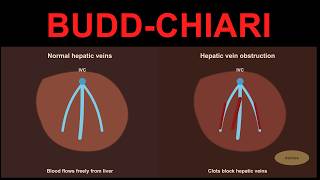 What is Budd Chiari Syndrome?  Definition, Symptoms, Causes, Treatment