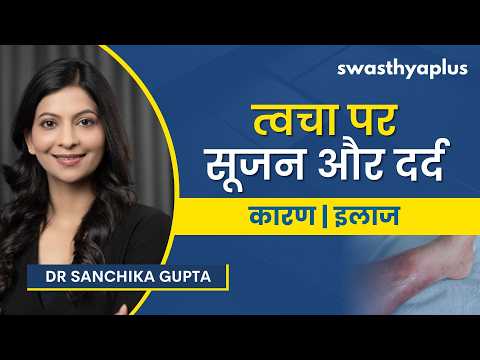 सेल्यूलाइटिस: लक्षण और इलाज | Cellulitis: Causes & Symptoms in Hindi | Treatment | Dr Sanchika Gupta
