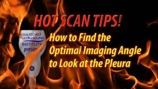 Hot Tip-How to Find the Optimal Imaging Angle to Look at the Pleura in a Pediatric Patient