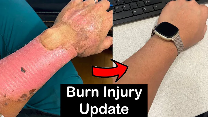 Long Term Healing Progress Of Second Degree Burns (3 Year Update)