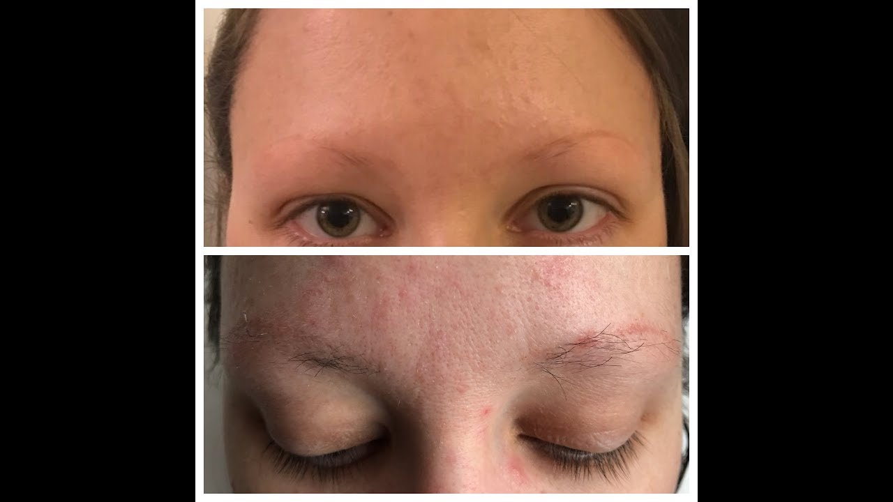 6 month eyebrow transplant update