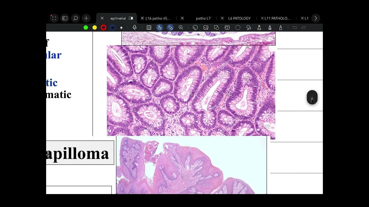 L17 GENERAL PATHOLOGY _ benign tumers