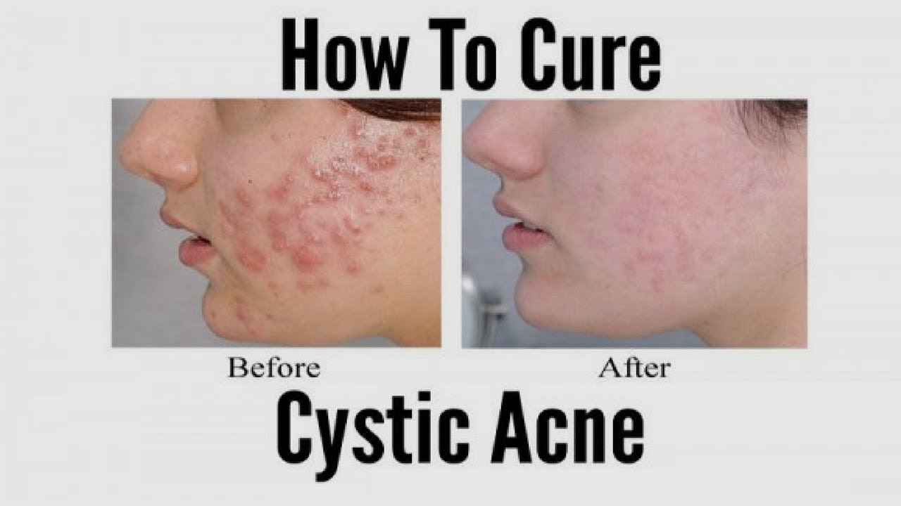 Cystic Acne Home Remedy Top 10 Natural ways to cure Cystic Acne