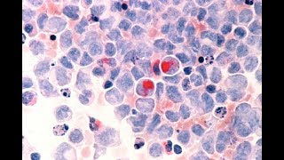 Improving outcomes for myeloid cancers