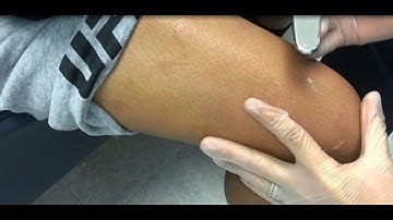 ConnecTX / Graston Technique (Knee) & MFR - Dr. Rick Rosa With UFC Fighter Shana “Danger” Dobson