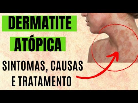 Vídeo: Dermatite Atópica: Sintomas, Tratamento, Fotos, Causas