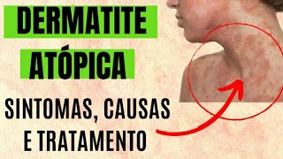 Dermatite Atópica - sintomas, causas, tratamentos