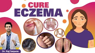 NO MORE ECZEMA | Get Rid of Itching & Eczema Naturally & Permanently At Home | Eczema Best Treatment