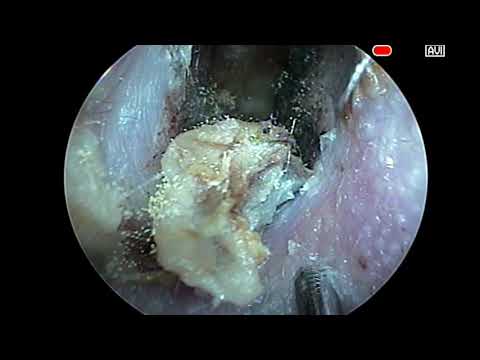 Mold in the ear. Плесень в ушах.