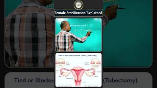 महिला नसबंदी कैसे होती है II Female Sterilization Explained
