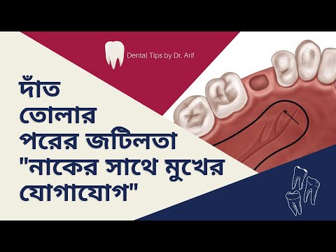 ভিডিও: চোয়ালের জয়েন্ট রিং করার 3 টি উপায়