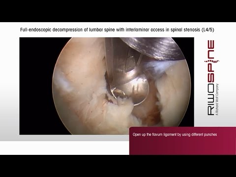 LUMBAR FORAMINAL STENOSIS. 