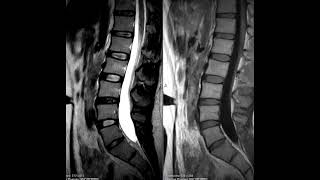 Vertebral Hemangioma
