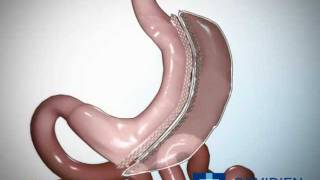 Sleeve Gastrectomy Educational video - Dr Vytauras Kuzinkovas