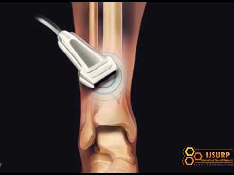 Tiny bubbles help heal broken bones