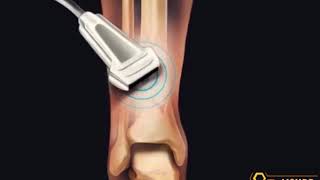 Tiny bubbles help heal broken bones