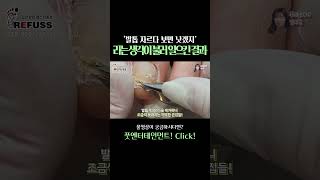 발톱 자르다 보면 낫겠지...라는 생각이 불러 일으킨 결과?? #레푸스 #일산레푸스 #내성발톱 #무좀발톱 #ingrown_toenail #일산내성발톱 #일산무좀발톱 #발톱