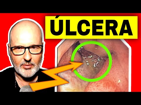 Vídeo: As úlceras duodenais sangram?