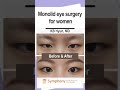 Monolid eye surgery for women natural transformation plastic surgery