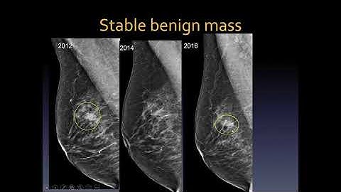 Mammography interpretation