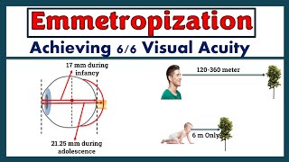 Emmetropization - The process of Achieving normal (6/6) Visual Acuity. screenshot 5