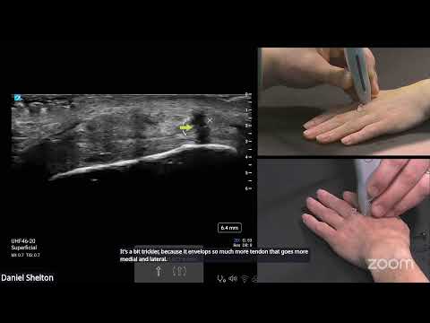 Image of Behind the Scan Webinar: Diagnostic Hand Ultrasound Part 3: Arthritic Hand