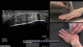 Behind the Scan Webinar: Diagnostic Hand Ultrasound Part 3: Arthritic Hand screenshot 3