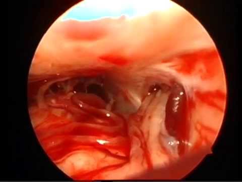 Neurosurgery: Trigeminal neuralgia - endoscope-assisted microvascular decompression - Dr. Bosnjak
