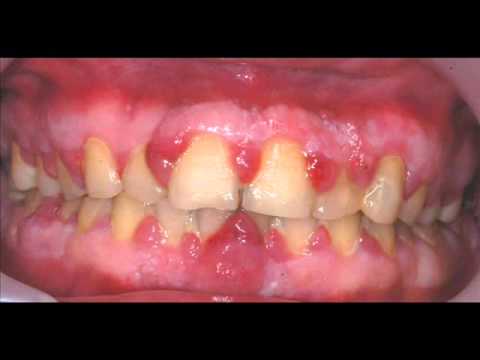 gingival curettage