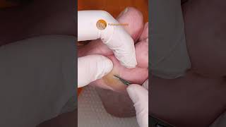 Apical and plantar callus extraction to relieve the patient #Shorts