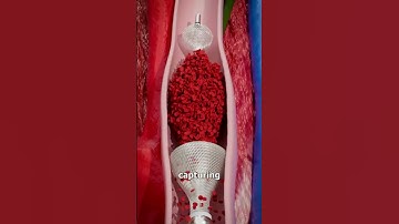 Removing Blood Clots with Vacuum 😨