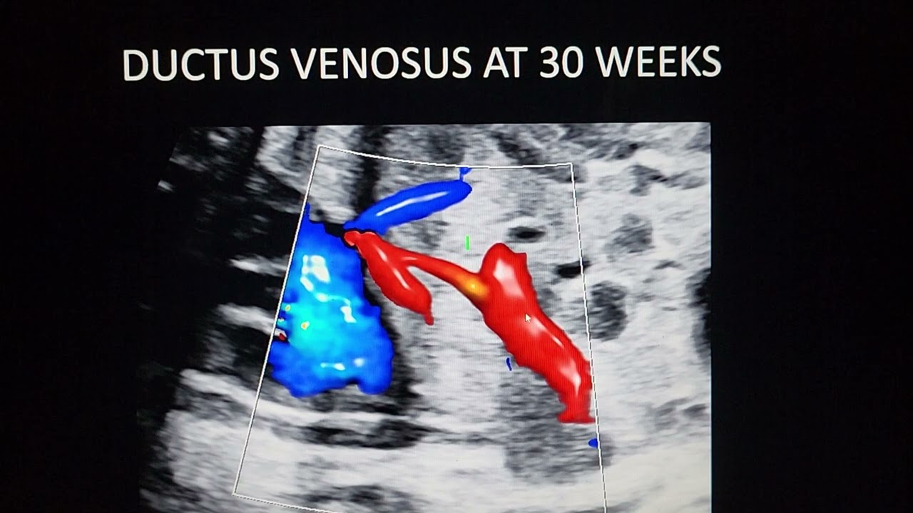 Agenesis of ductus venosus-Fetal echo teaching under REFER series by Dr Pradeep srinivasan
