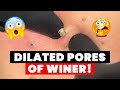 DILATED PORES OF WINER!