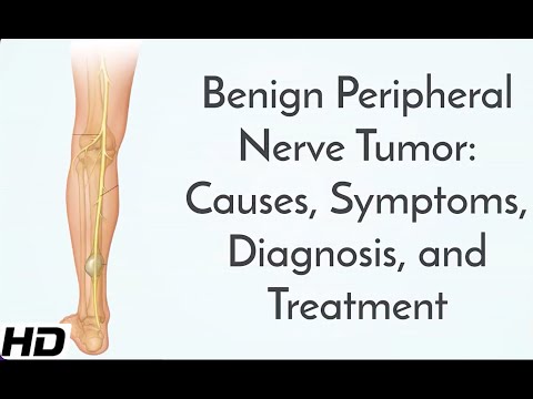 Video: Schwannoma - causes, symptoms, diagnosis and treatment