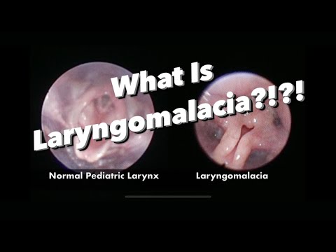 Video: Laryngomalacia: Behandling, årsager, Diagnose, Outlook Og Mere