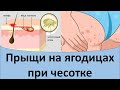 Прыщи на ягодицах при чесотке