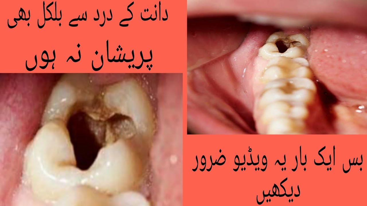 How To Treat Tooth Pain At Home/Home Remedy For Toothache/دانت کے درد