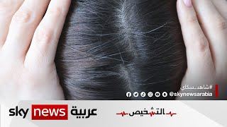 الخلايا الجذعية لزراعة الشعر وعلاج الحروق | #برنامج_التشخيص