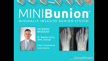 MINIBunion: MIS Bunion System -  Webinar with Dr. Bradley Lamm