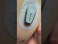 Skadoosh The Diabetes Diabetes T1d Type1diabetes Dexcom Dexcomg6 Expressionmed Skadoosh The Diabetes Diabetes T1d Type1diabetes Dexcom Dexcomg6 Expressionmed