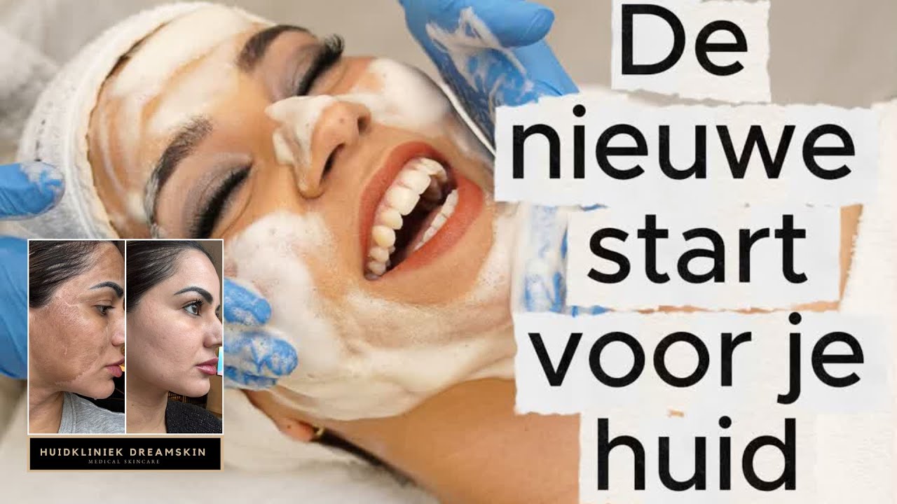 CosmoPeel Forte Behandeling/ medische TCA-peeling