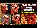 Clogged Arteries? Beat Plaque from Arteries Without Surgery
