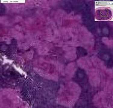 Histopathology Lymph node--Langerhans cell histiocytosis (Ha - YouTube