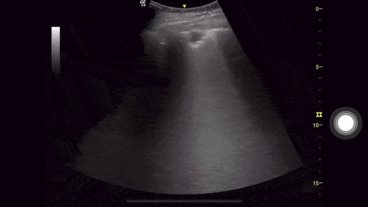 Subpleural Consolidation in COVID 19 Pneumonia