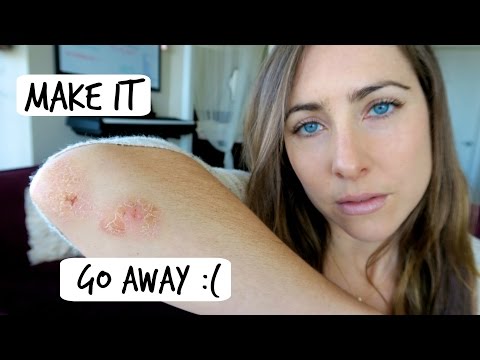 Getting serious about healing my Leaky Gut & Psoriasis // iHerb Haul