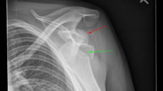 Bilateral shoulder dislocation